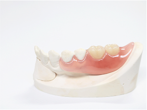 ノンクラスプデンチャー