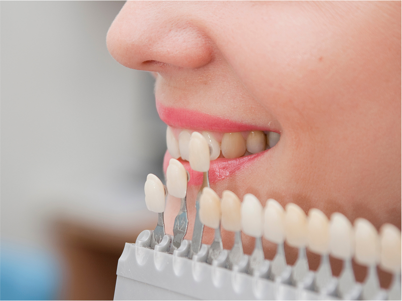 ホワイトニング